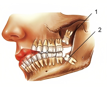 Wisdom Teeth Extraction
