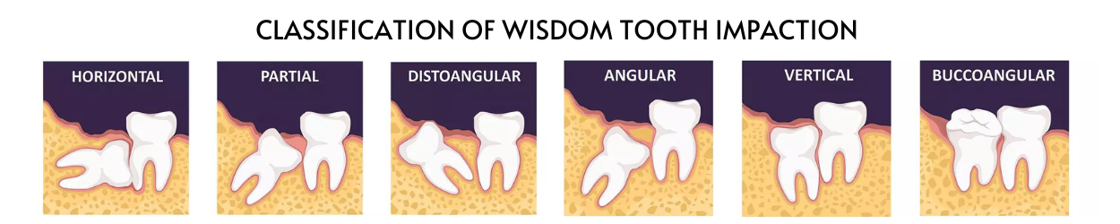 Wisdom Teeth Extraction